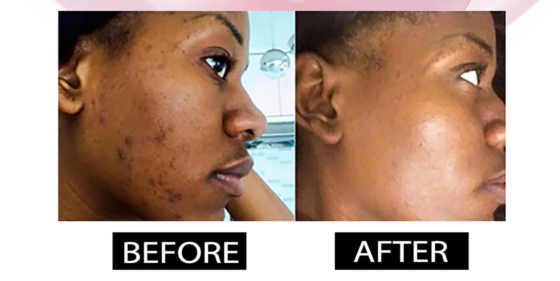 AILKE Dark Spot Remover Serum,Nourishing, Lightening, Even Skin Tone, Anti-aging Freckle, For Face, Body, Women Personal care